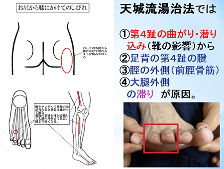 天城流医学大全集 手・指の痛みシビレ編 天城流湯治法 - その他